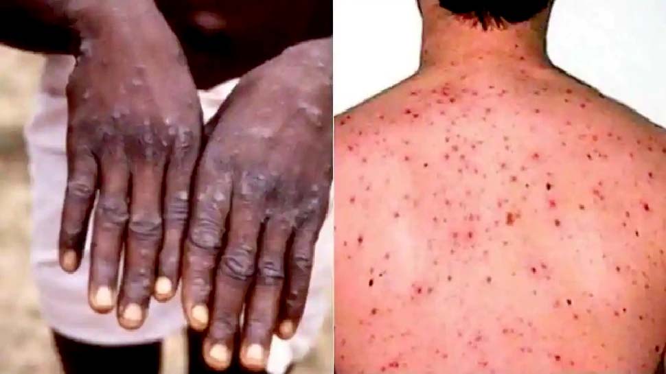 बेलायतमा मंकीपक्सः यौन सम्पर्कबाट जोगिन सरकारको निर्देशन